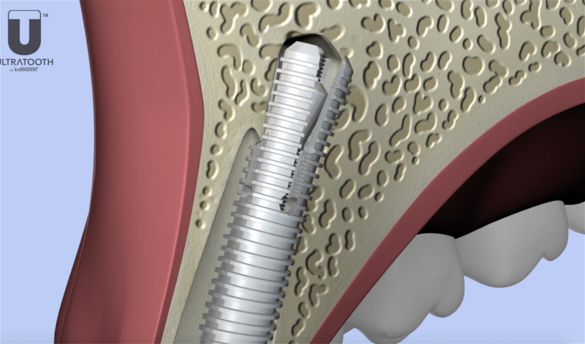 The UltraTooth (also known as the Sargon Implant) is placed in the tooth socket and expands to contact the bone immediately, proving an immediate anchor.