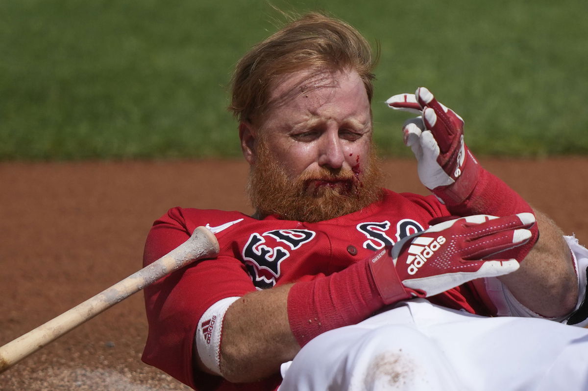 Justin Turner: Boston Red Sox third baseman receives 16 stitches