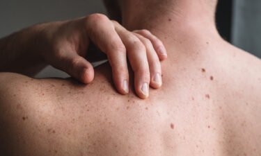New data from a trial of an investigational mRNA vaccine shows that it reduced the risk of recurrence of the serious skin cancer melanoma when combined with immunotherapy
