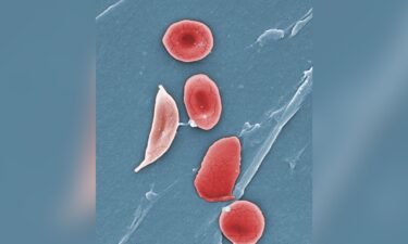 This microscope image shows a sickle cell (left) and normal red blood cells of a patient with sickle cell anemia.