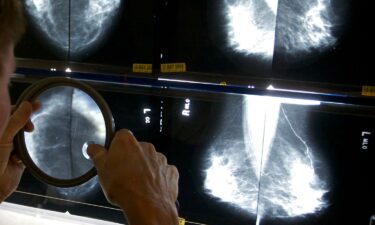 A radiologist uses a magnifying glass to check mammograms for breast cancer.